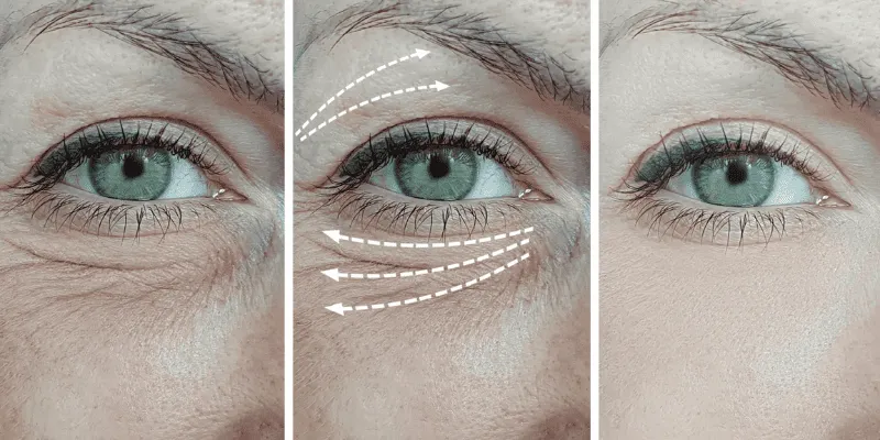 cirugía-de-parpados-blefaroplastia